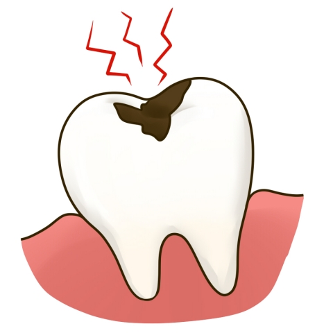 toothdecay